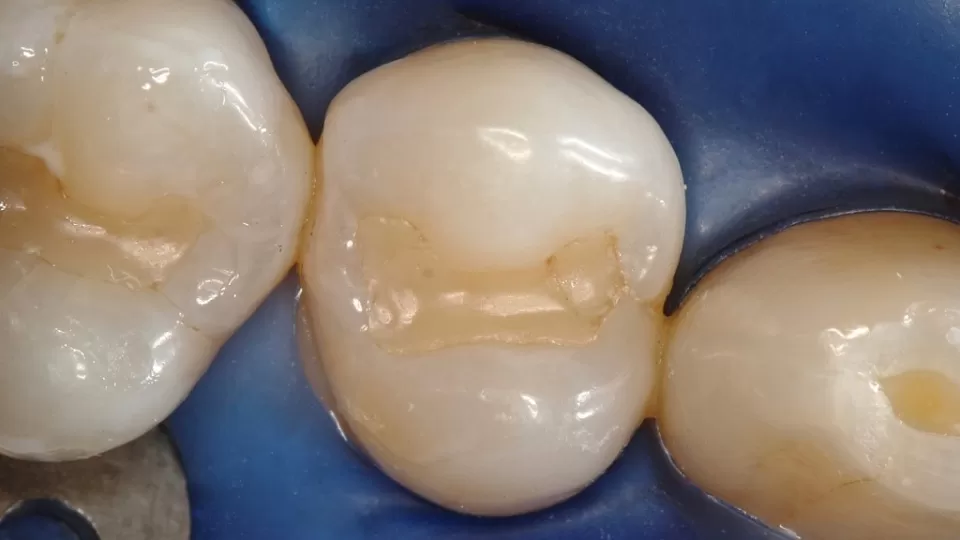 Зуб четверка со старой пломбой, нарушено краевое прилегание. Лечащий врач - Меликов Азер